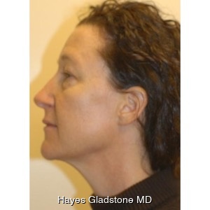 Before-Liquid Facelift