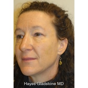 After-Liquid Facelift