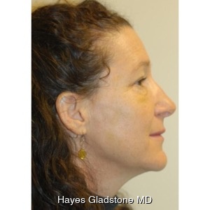 After-Liquid Facelift