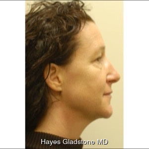 Before-Liquid Facelift