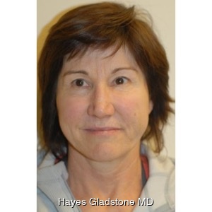 After-Liquid Facelift