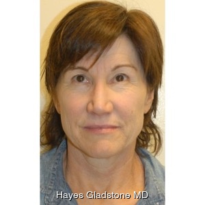 Before-Liquid Facelift