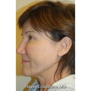 After-Liquid Facelift