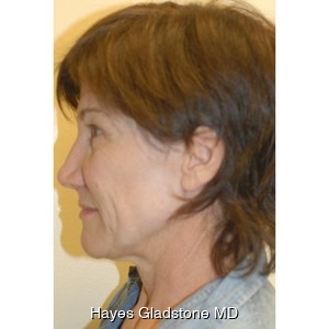 Before-Liquid Facelift