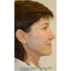 After-Liquid Facelift