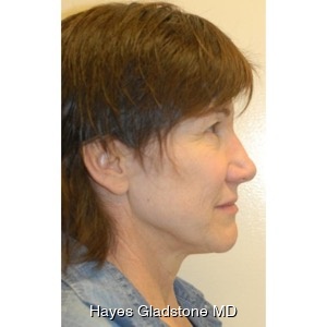 Before-Liquid Facelift