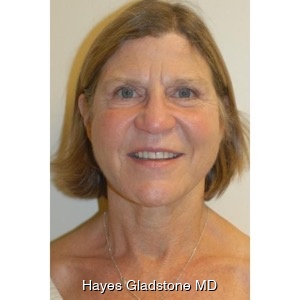 After-Liquid Facelift