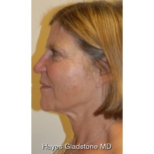 After-Liquid Facelift