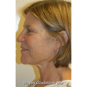 Before-Liquid Facelift