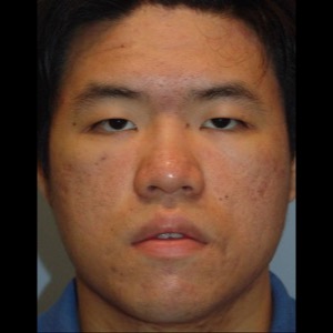 After-Laser Skin Resurfacing