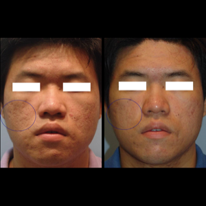 Before-Laser Skin Resurfacing