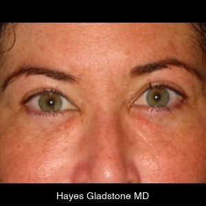 After-Undereye Tear Trough Injection