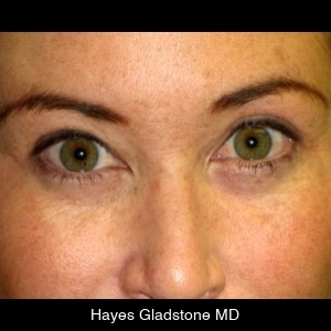Before-Undereye Tear Trough Injection