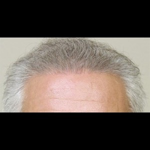 After-Hair Restoration