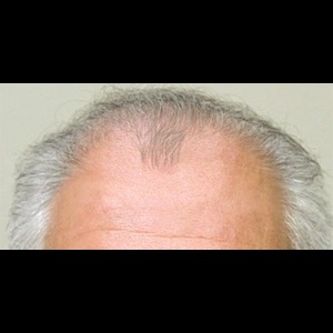 Before-Hair Restoration