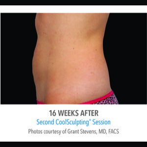 After-CoolSculpting