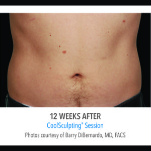 After-CoolSculpting
