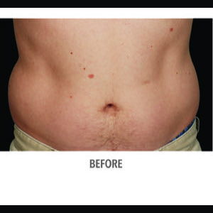 Before-CoolSculpting