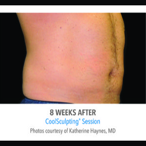 After-CoolSculpting