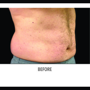 Before-CoolSculpting
