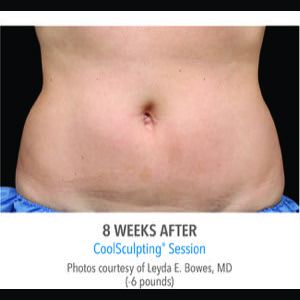 After-CoolSculpting