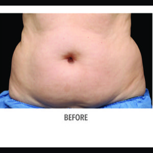 Before-CoolSculpting