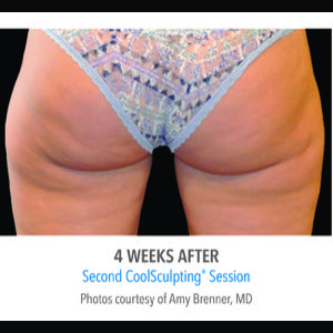 After-CoolSculpting
