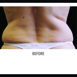 Before-CoolSculpting