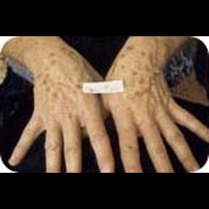 Before-Laser Skin Resurfacing