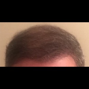 After-Hair Restoration