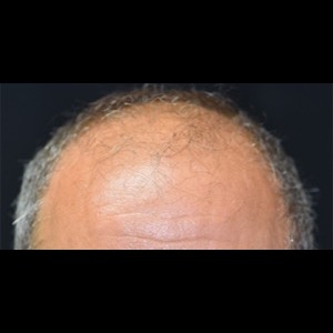 Before-Hair Restoration