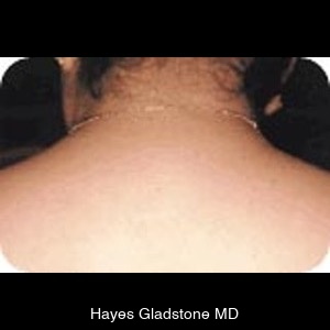 After-Laser Hair Removal