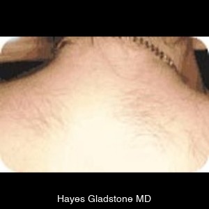 Before-Laser Hair Removal