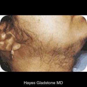 Before-Laser Hair Removal