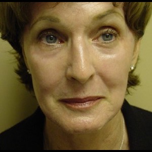After-Laser Skin Resurfacing