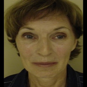 Before-Laser Skin Resurfacing