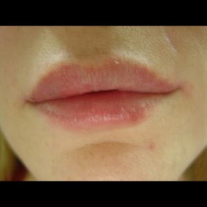 After-Lip Augmentation