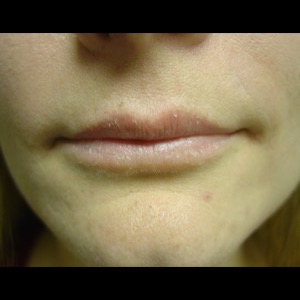 Before-Lip Augmentation