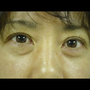 Before-Lower Blepharoplasty