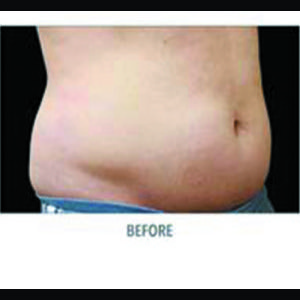Before-CoolSculpting