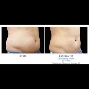 Before-CoolSculpting