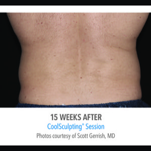 After-CoolSculpting