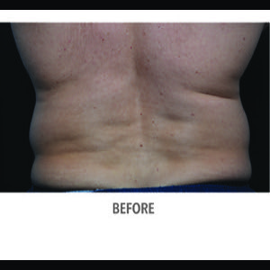 Before-CoolSculpting