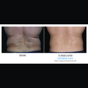 After-CoolSculpting
