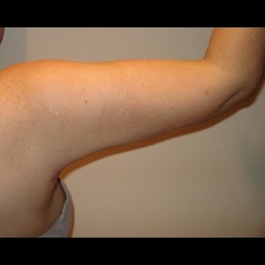 After-Mini Brachioplasty