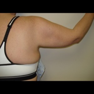 Before-Mini Brachioplasty