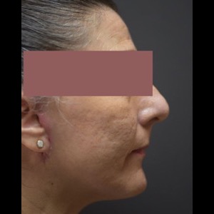 After-G Lift - Right
