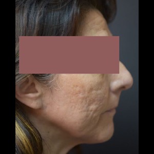 Before-G Lift - Right
