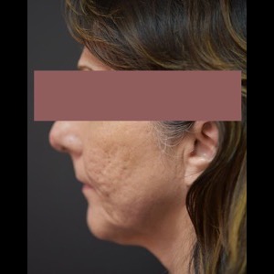 Before-G Lift - Left