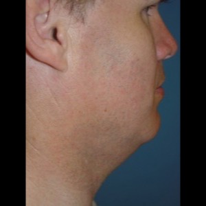 Before-Neck Liposuction